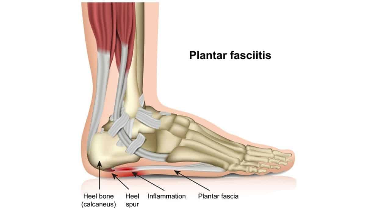 Fascitis plantar solución